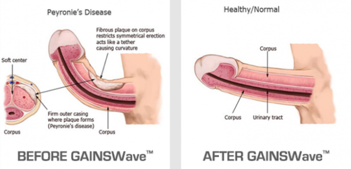GAINSWave erectile dysfunction treatment